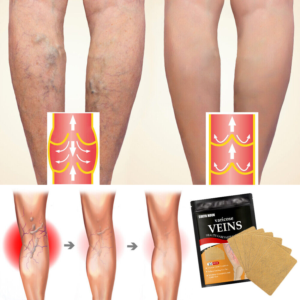 VEINPAT